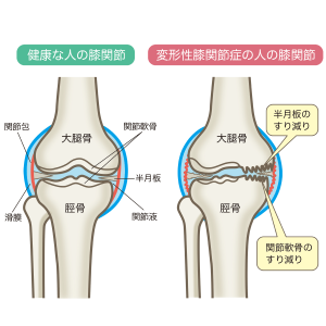 osteoarthritis-of-the-knee